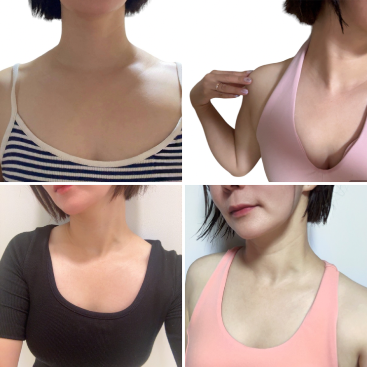  대전승모근주사 2주차 전후사진, 효과,가격,후기