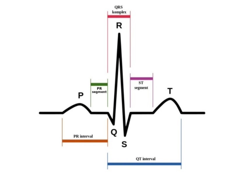 Vtach : 심실빈맥, Ventricular tachycardia, pulseless VT, EKG 리듬 / 제세동기 적응증
