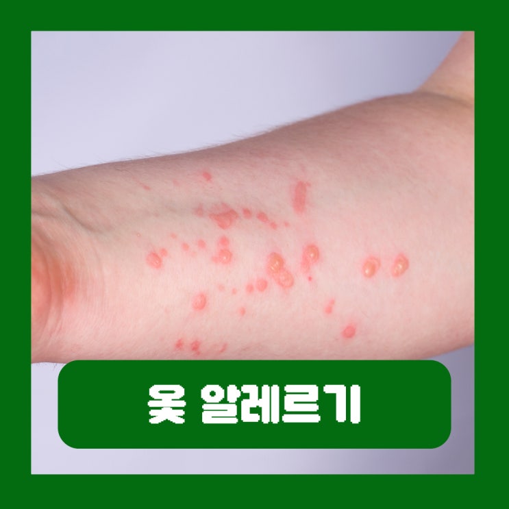  옻 알레르기 증상 중독 원인 전염 올랐을때 피부과 약 치료