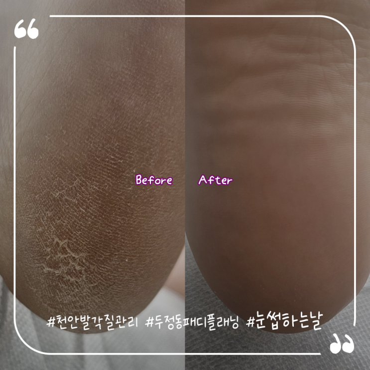  천안발각질관리 발각질케어 두정동패디플래닝 눈썹하는날