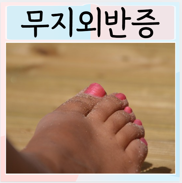  무지외반증 증상 예방 관리 치료 발가락운동