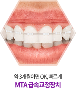  강남구치아교정전문 어디가 좋을까?