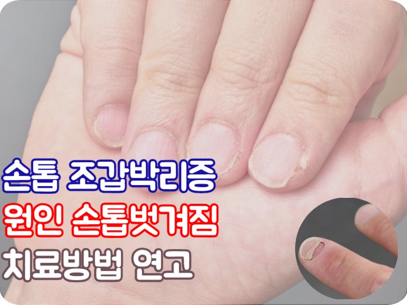 손톱 조갑박리증 원인 손톱 벗겨짐 연고 치료방법