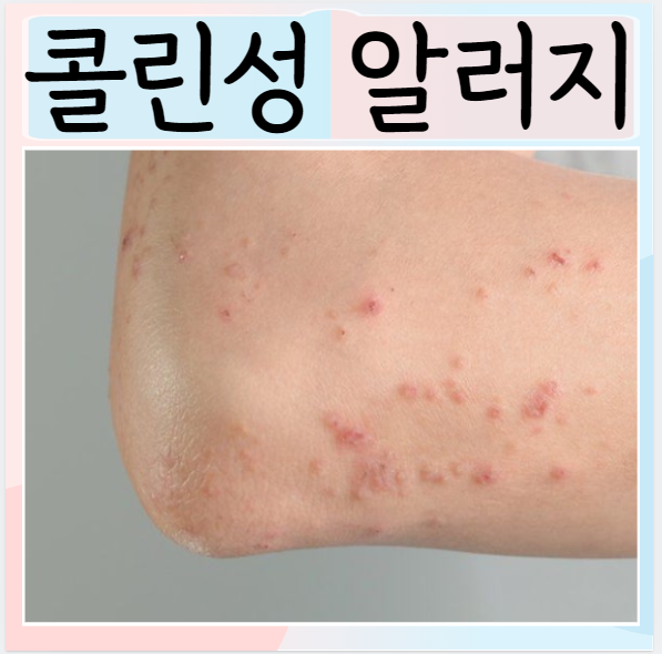  콜린성 알레르기 치료 증상 원인 예방법 빨간점 두드러기