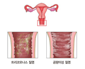  연재5. 질염의 모든것