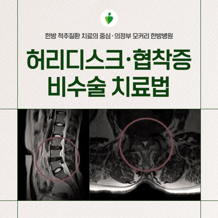  포천허리디스크 척추관협착증 비수술 치료 | 의정부 모커리한방병원