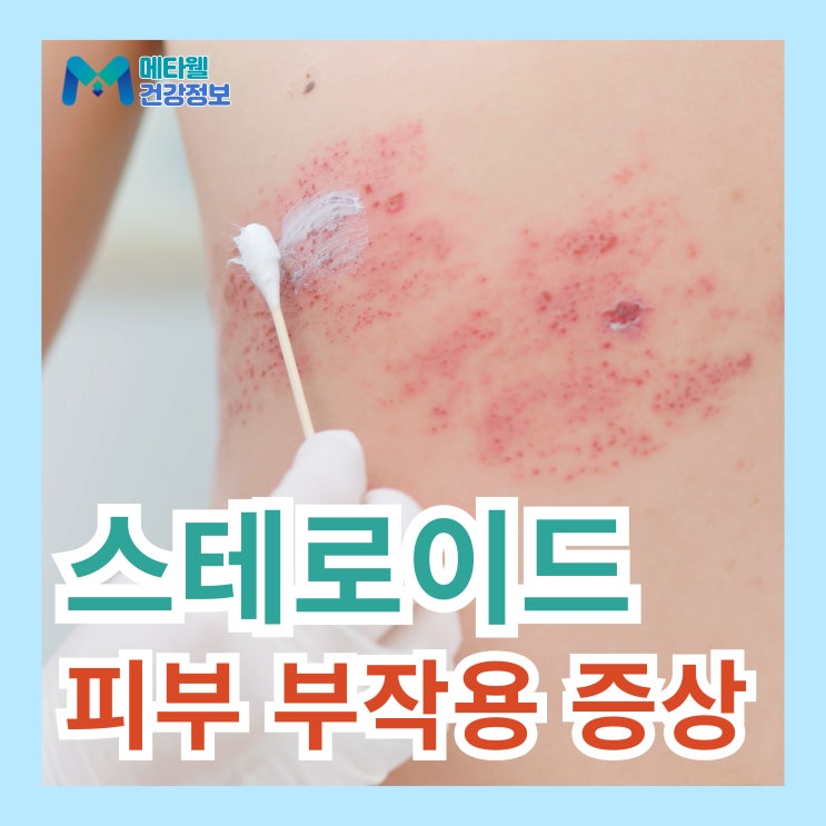 아토피 피부염 치료시 꼭 주의해야할 스테로이드 피부 부작용 증상