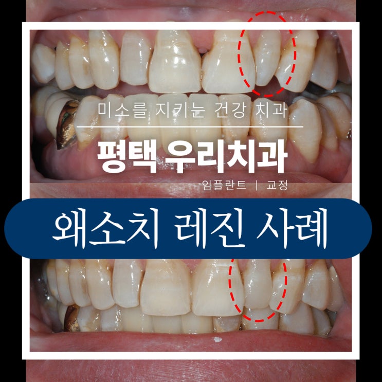  평택 왜소치 레진 치과 왜소치치료 후기 사례