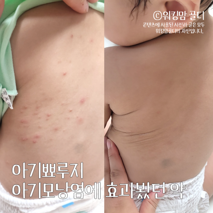  아기뾰루지 아기모낭염 이렇게 해결!