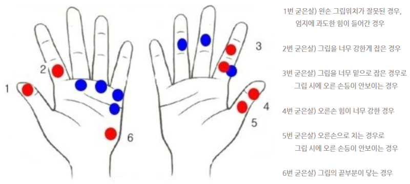 골프 그립별 굳은살 위치와 원인 분석