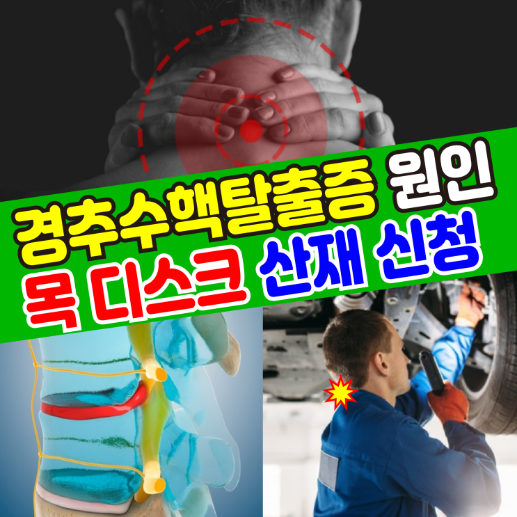  [기본정보] 경추 수핵 탈출증(증상, 치료, 원인) 목 디스크 산재 신청