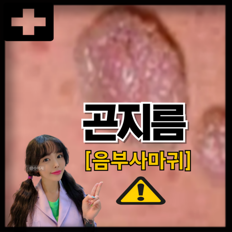  여자 남자 곤지름 증상 원인 질 음부 항문 생식기 사마귀 외음부 곤지름 콘딜로마 치료
