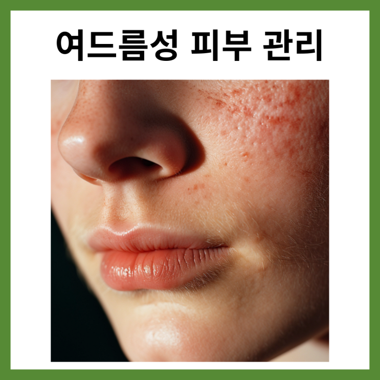  여드름성 피부 관리