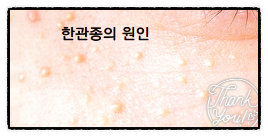  한관종 비립종과 달라요
