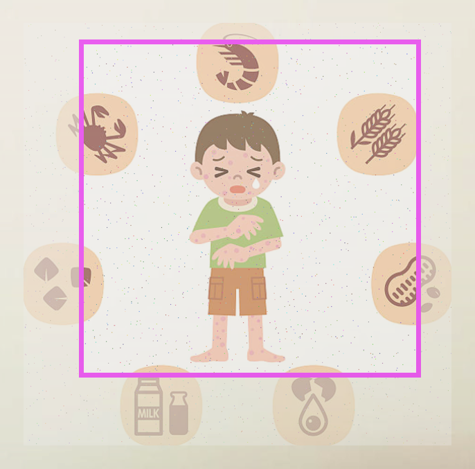  담석증과 비만의 연관성