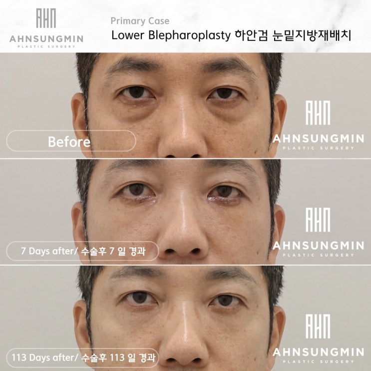  중년 남성 눈밑 지방재배치 잘하는 병원, 안성민 성형외과