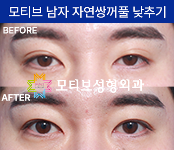 높은 자연쌍꺼풀 낮추는 방법 (쌍꺼풀 없애는 수술, 겹쌍꺼풀)