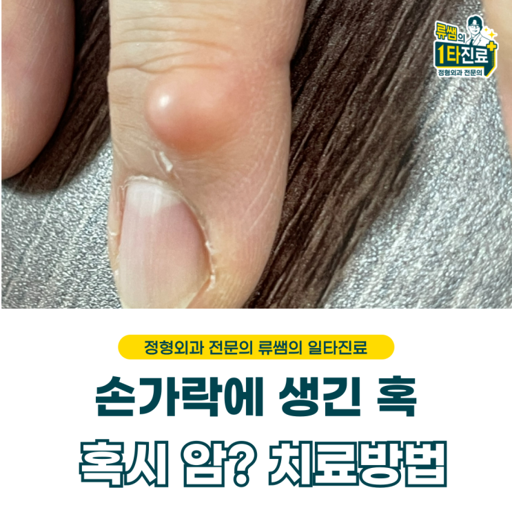  손가락에 생긴 혹, 혹시나 암? 결절종 치료 (의사작성)