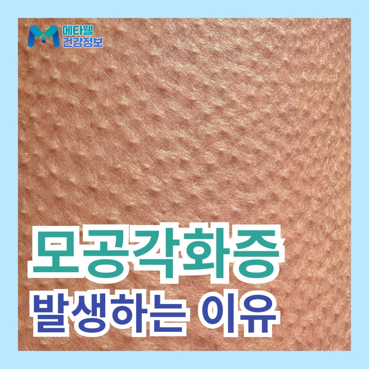  피부 모공각화증 발생 원인, 팔뚝 다리 모공에 각질 모공성 각화증