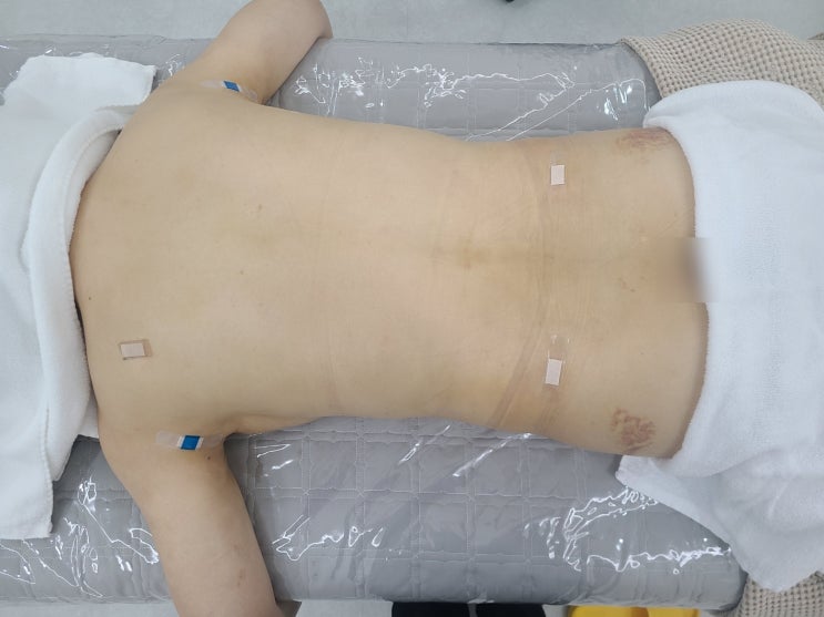  등 지방흡입 후 고주파 관리하면 생기는 변화