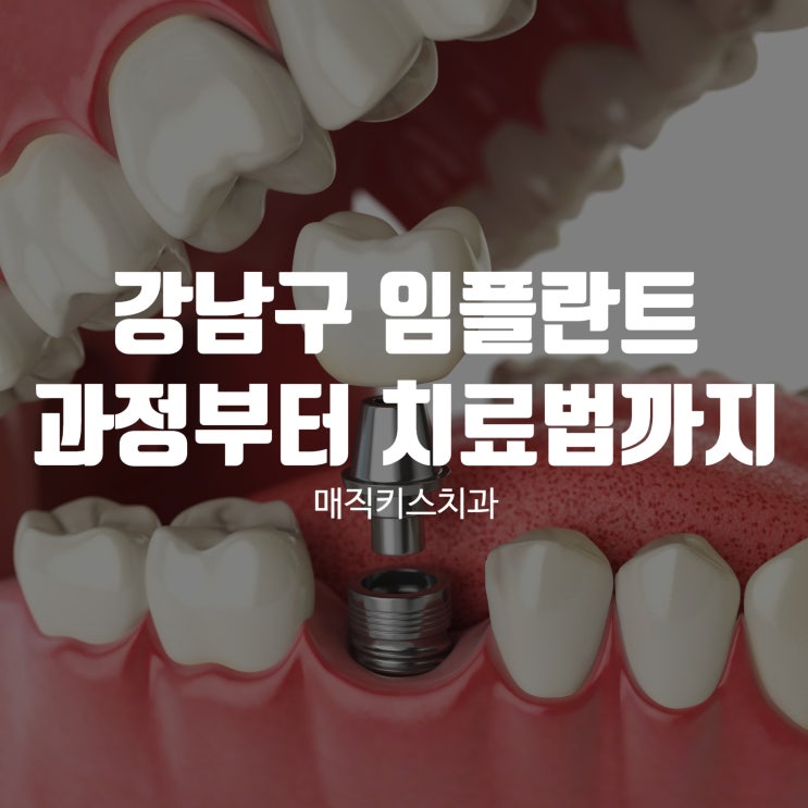  강남구 임플란트, 임플란트 치료과정부터 대체 치료법까지
