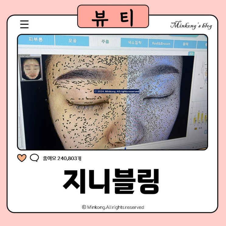  안산 고잔동피부관리 샵 리프팅 추천 - 지니블링