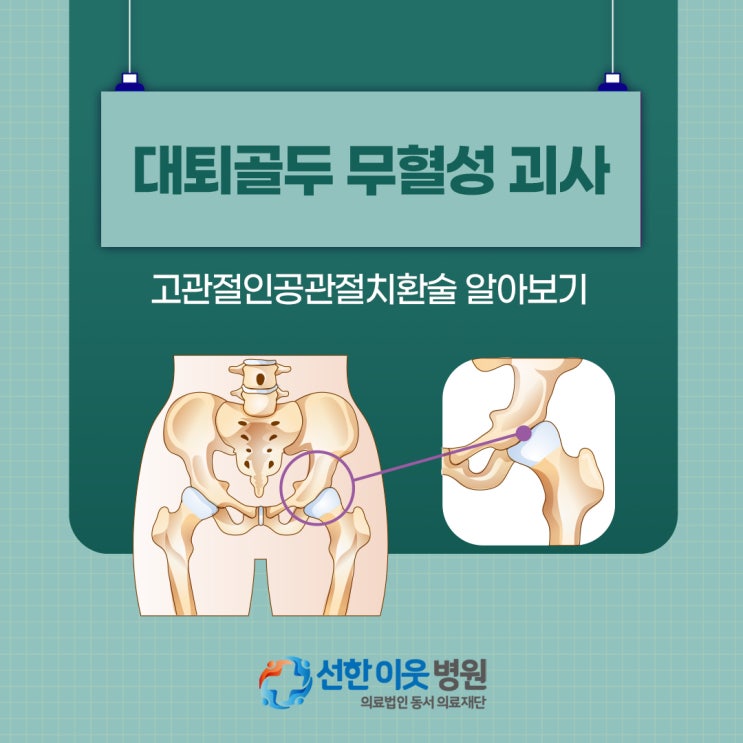 대퇴골두무혈성<b>괴사</b>증상 고<b>관절</b><b>인공관절</b>치환술 알아보기