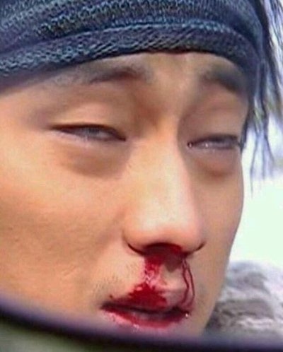 이대서울병원 부비동염 비중격만곡증 수술 후기