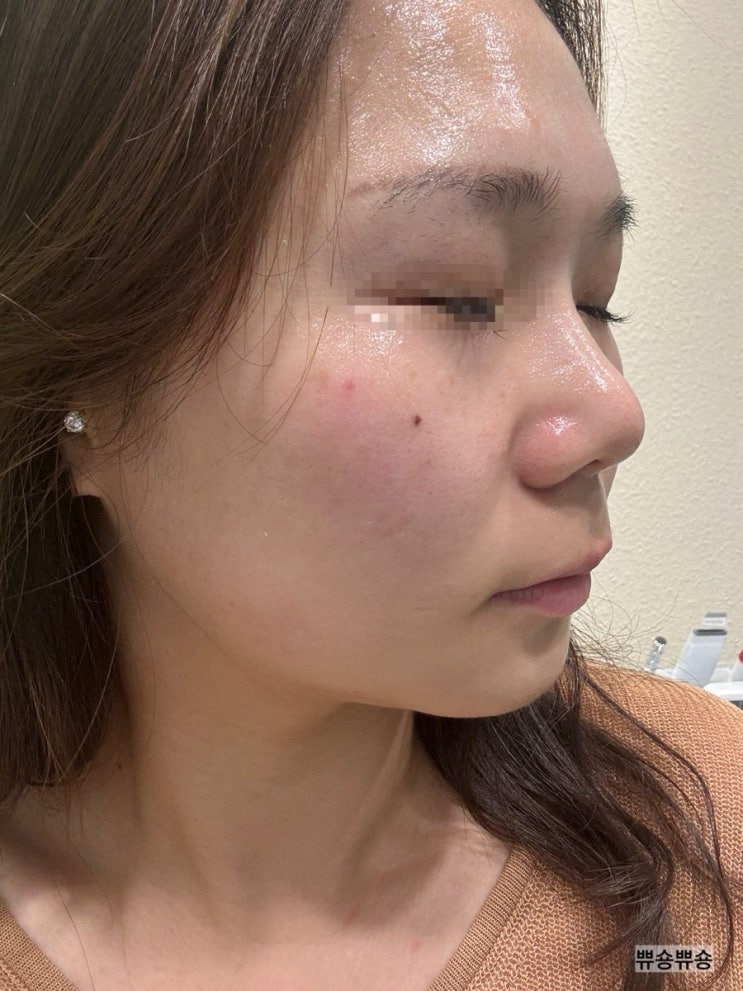  전농동 피부관리 듀얼 리프팅 관리 바나나부띠끄