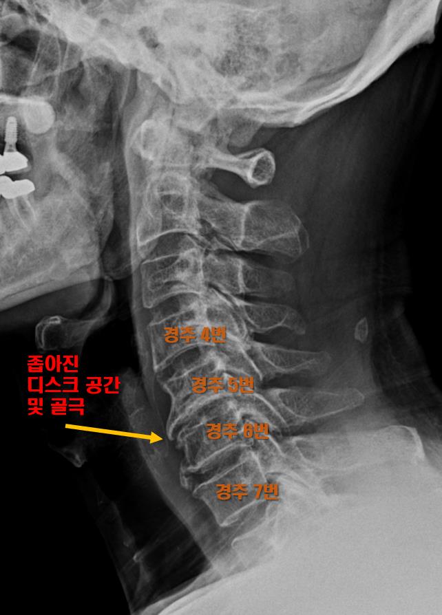  백운동 정형외과, 경추협착증으로 고생 중인 환자분 case
