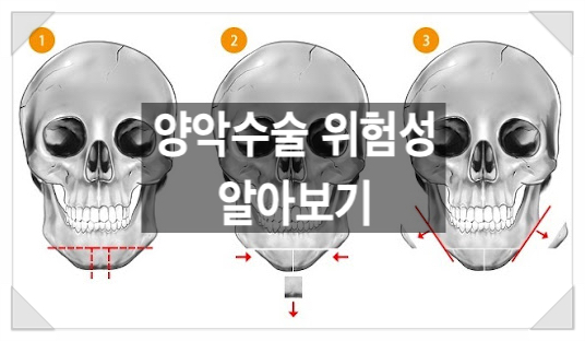  "양악수술의 위험성, 제대로 알아보자"