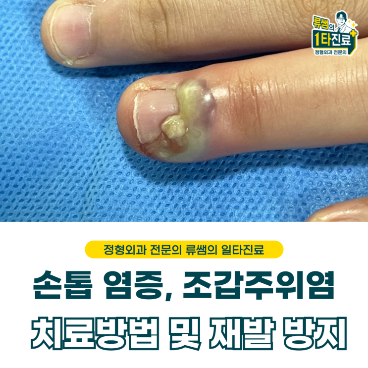  손톱 물어뜯다가 생긴 손톱 주위 고름, 조갑주의염 치료 (의사 작성)