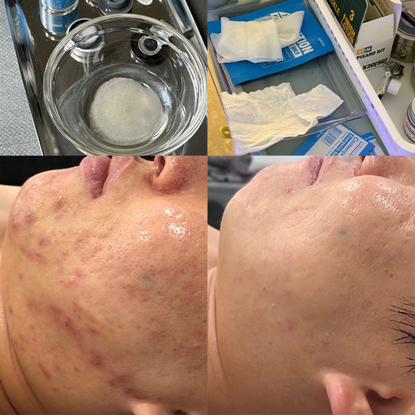  [서초/구반포] 여드름 압출 꼼꼼하게 잘하는 곳,1인 피부샵 제리라이크 대표원장 1:1관리