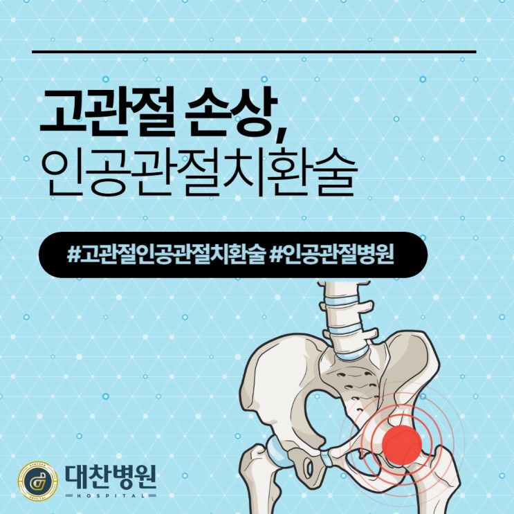 고<b>관절</b> 통증 무시하다가 대퇴골두에 <b>괴사</b>가? 고<b>관절</b><b>인공관절</b>치... 