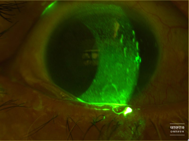 각막염, 필라멘트 각막염, Filamentary Keratitis