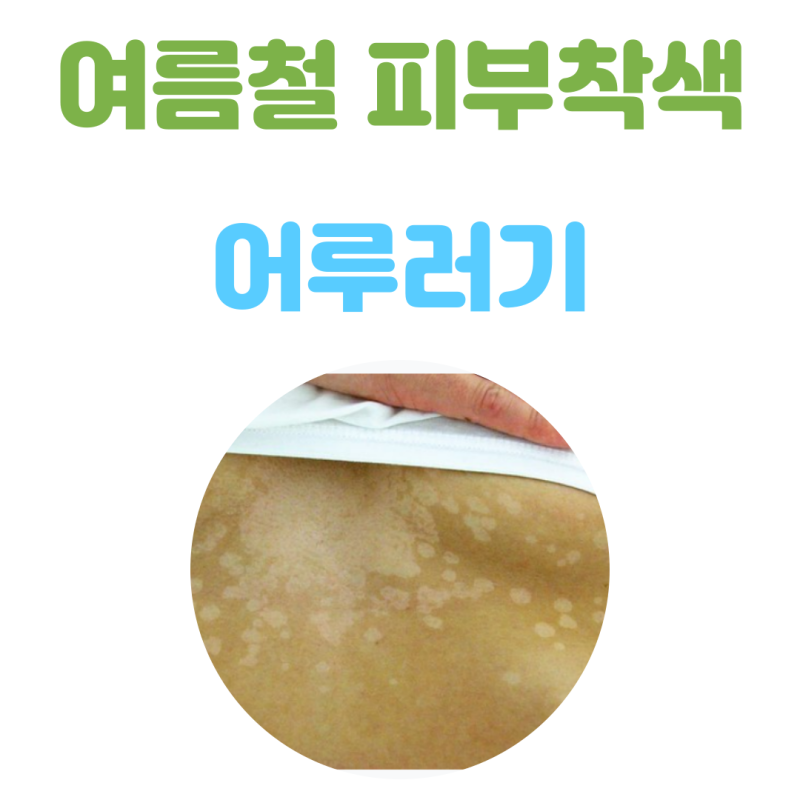 피부 착색의 원인 어루러기의 치료 (ft. 피부과 처방 연고, 니조랄)