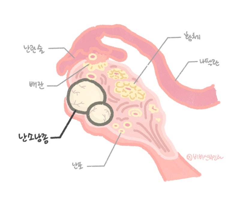 난소에 물혹이 있대요 – 난소양성종양 1편,기능성낭종. 매교역산부인과