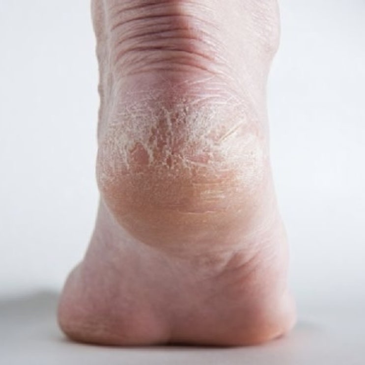  발뒤꿈치 굳은살 각질제거 발관리 방법 어떻게?
