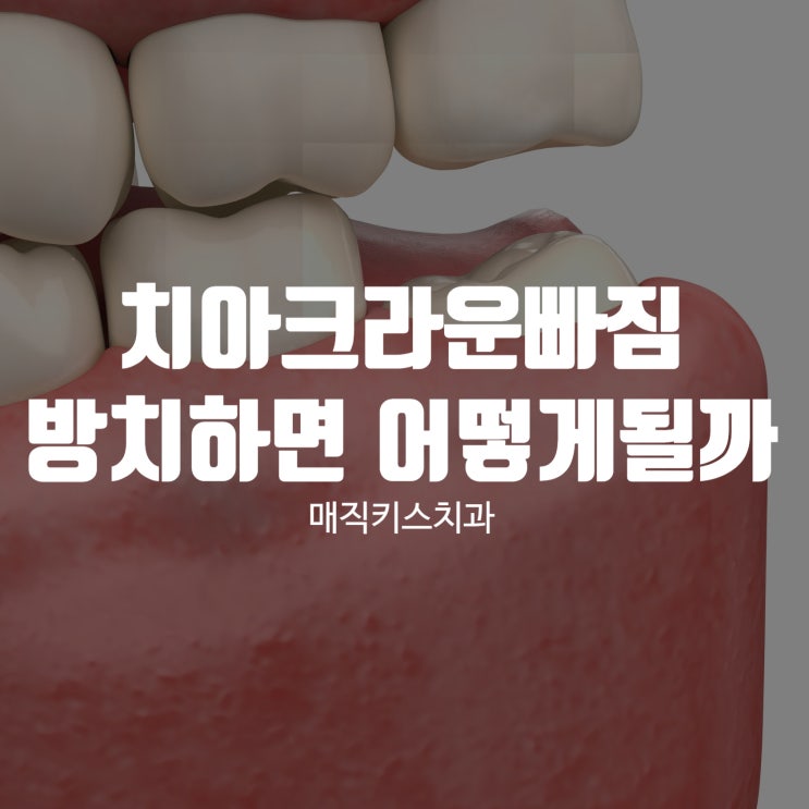  치아크라운빠짐 그대로 두면 어떤 일이 발생할까?