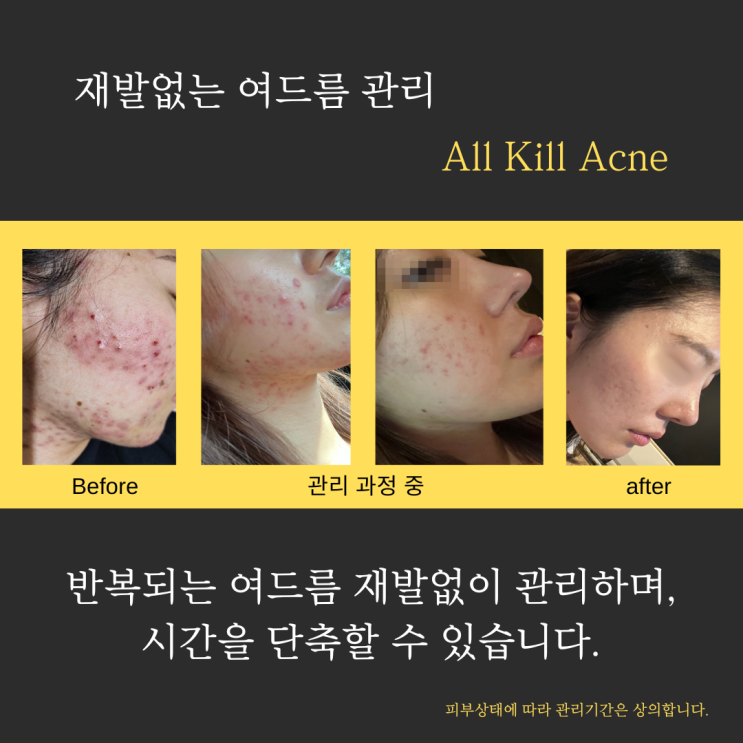  부천피부관리 여드름이 재발하는 이유