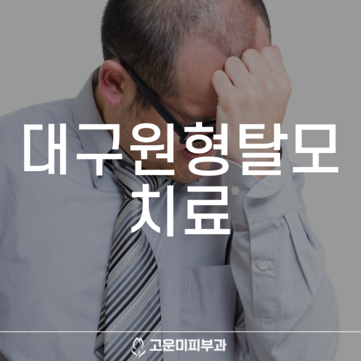  대구탈모치료 원형탈모 방치하면 점점 커지고 영구 탈모가 진행될 수 있어 조기 치료가 중요합니다