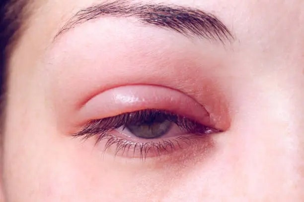 눈 밑 다래끼 초기증상 완벽 가이드 건강한 눈 관리 팁