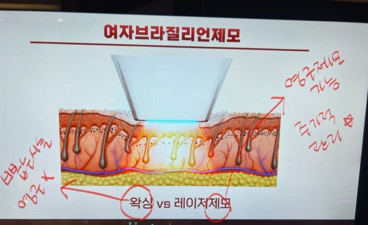  강남레이저제모 - 강남역 비키니라인 제모 브라질리언제모병원 다녀온 찐후기