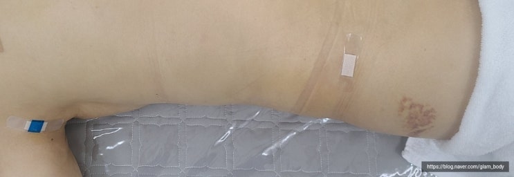  등 지방흡입후관리_바이오본드는 언제 생기고 왜 생기는 걸까?(바본관리-고주파)