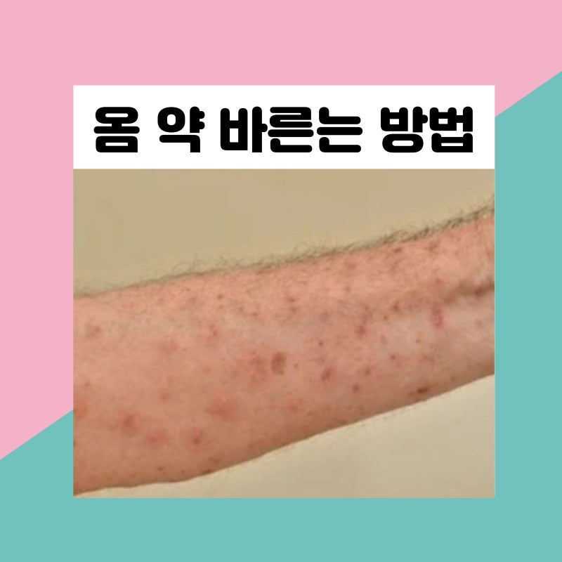 옴 완치 및 사진 초기 증상 치료 대처법 정리 : 네이버 블로그
