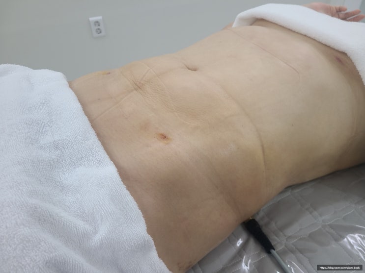  지방흡입 후관리샵에서 알려주는! 압박복의 중요성!