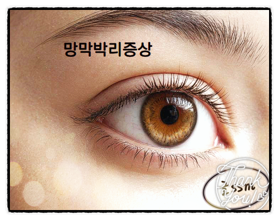 망막박리증상 실명위험까지