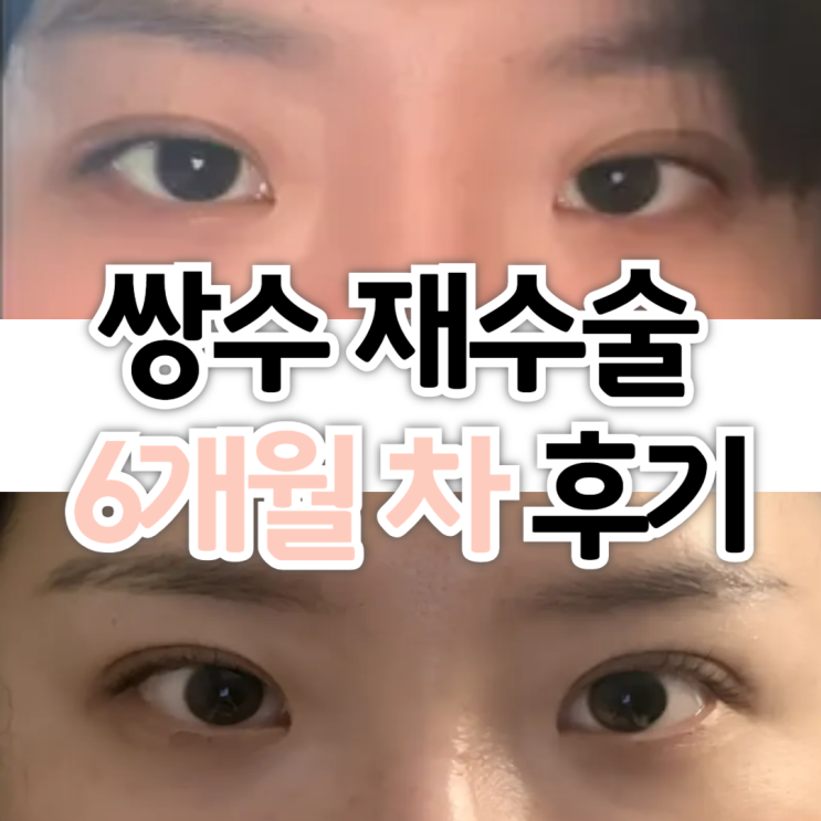  [절개 재수술, 눈매교정, 앞트임] 쌍수 6개월차 후기