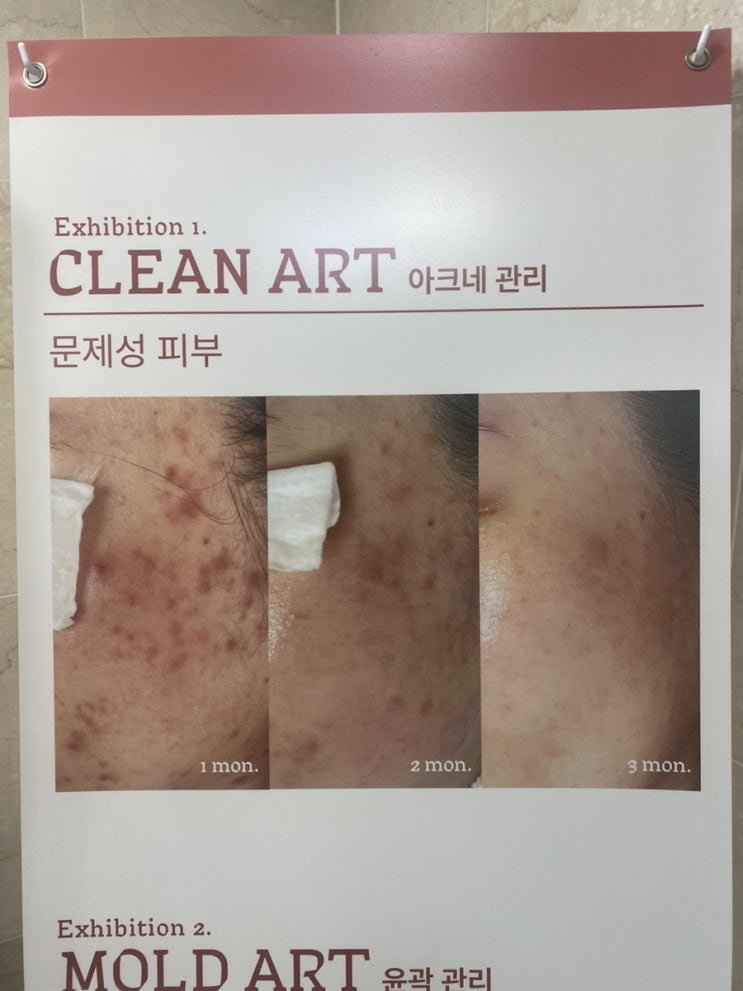  해운대여드름관리 문제성피부 고민 끝 헤스티움 센텀점