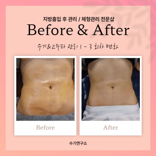  복부지방흡입 유착 되기 전에 가장 먼저 아셔야 할 것들